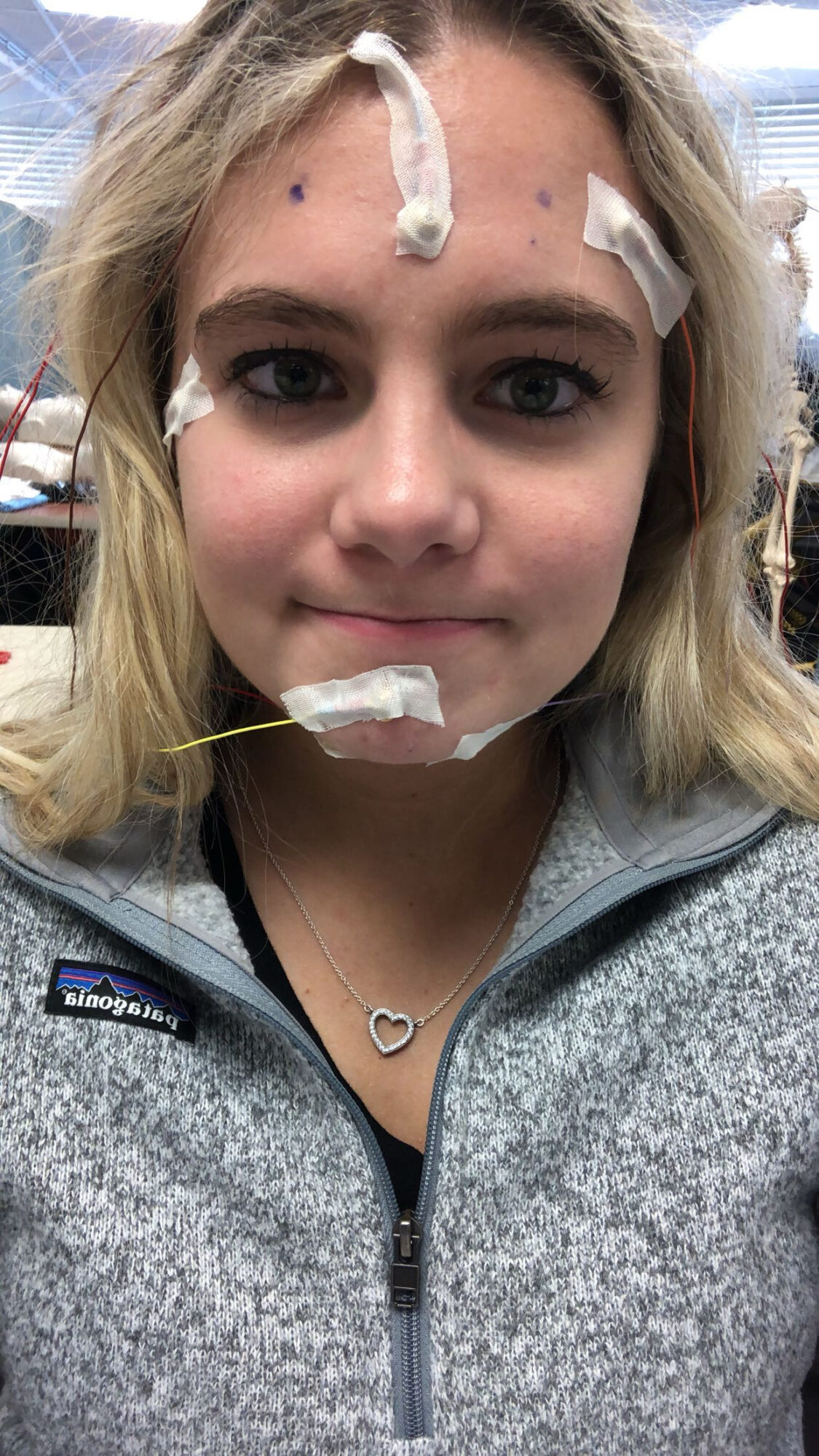 Young woman with medical tape on forehead and chin, wearing a gray zip-up jacket and a heart-shaped necklace.