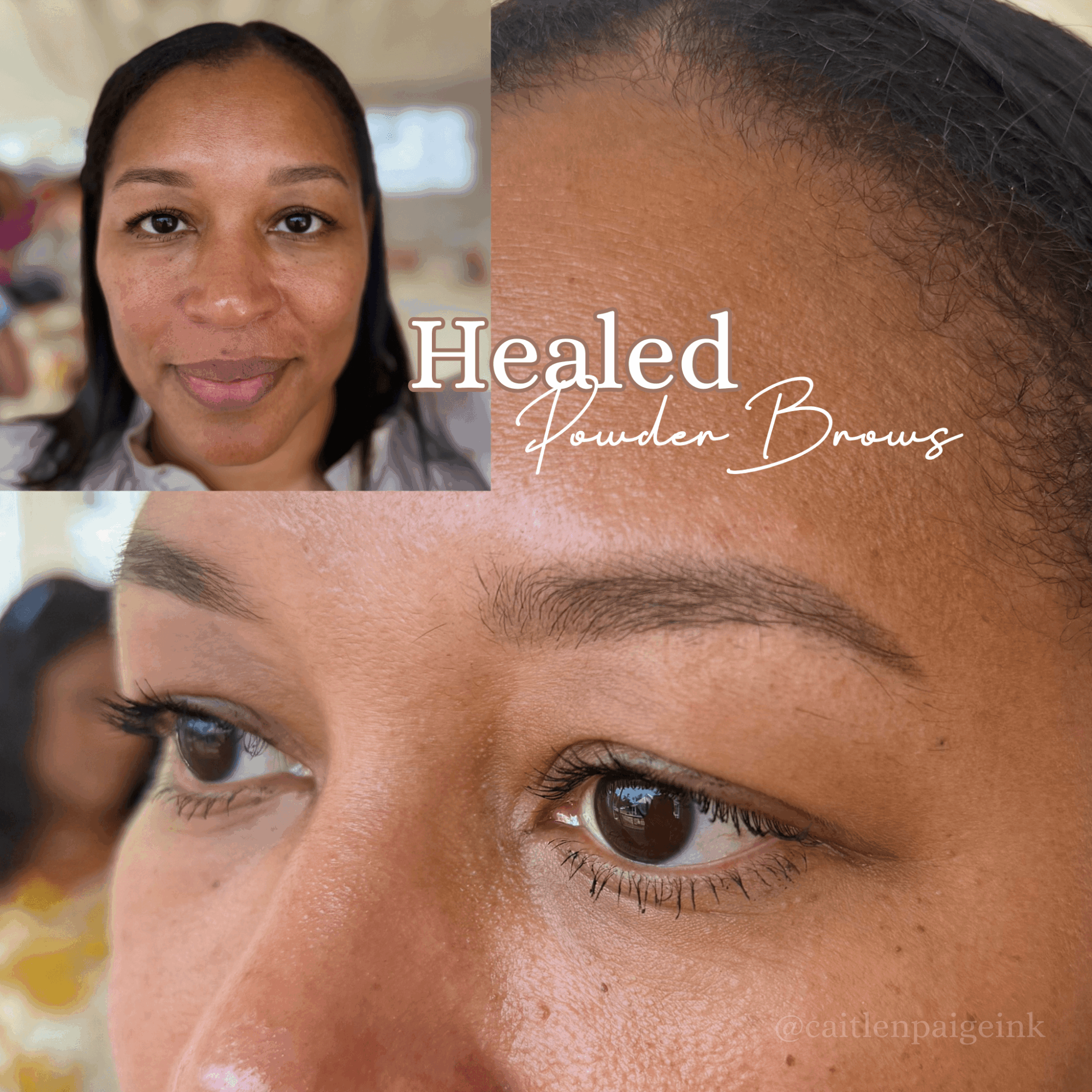 Close-up of a woman's face showing healed skin, with a smaller inset of her smiling face and a side view of her forehead.