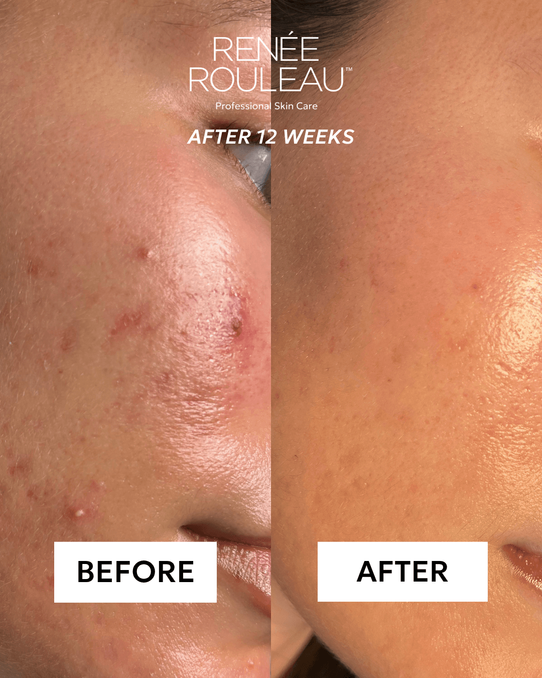 Side-by-side comparison of skin before and after 12 weeks showing improvement in acne scars and skin texture.