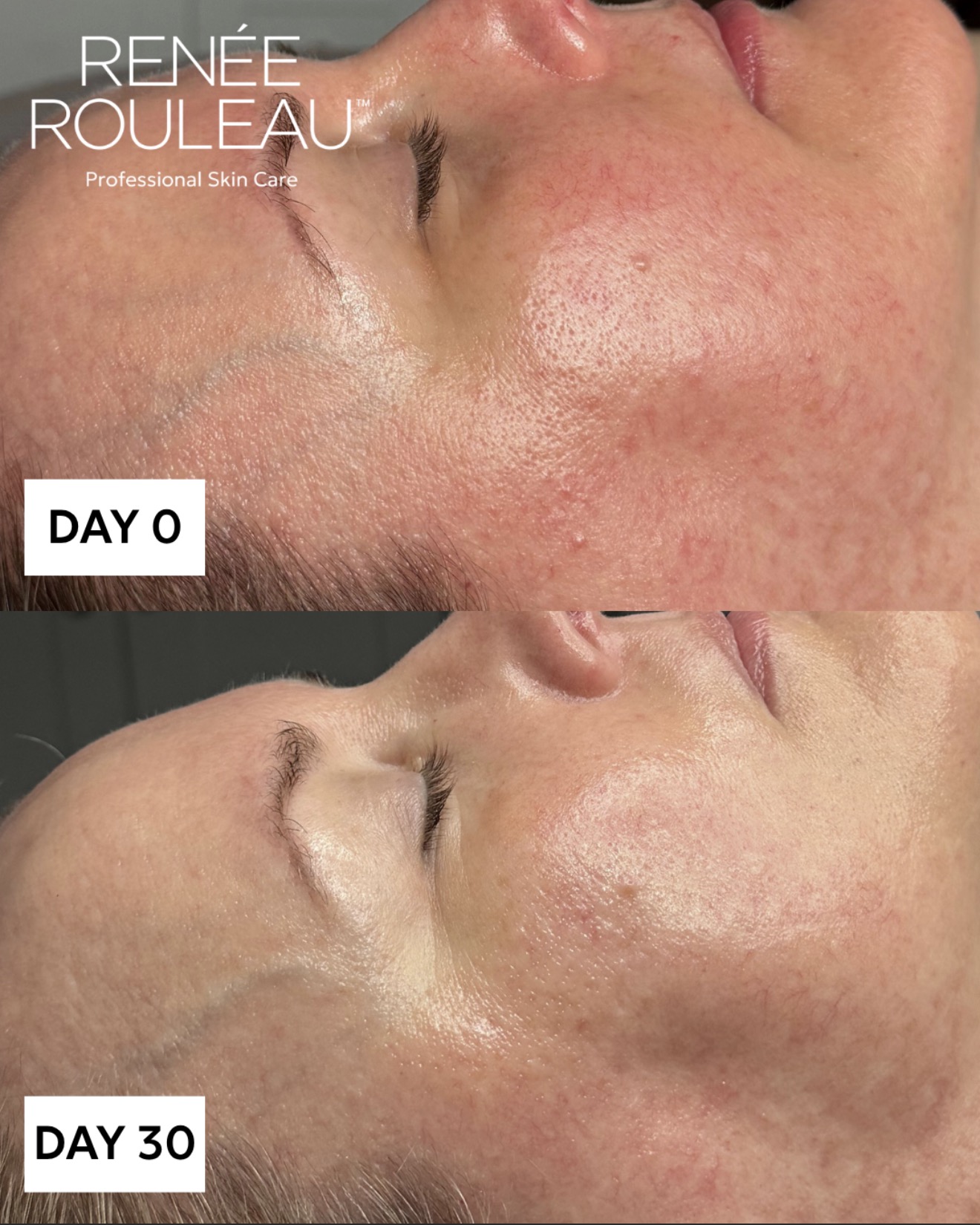 Comparison of skin condition before and after 30 days, showing improved skin texture and reduced redness.