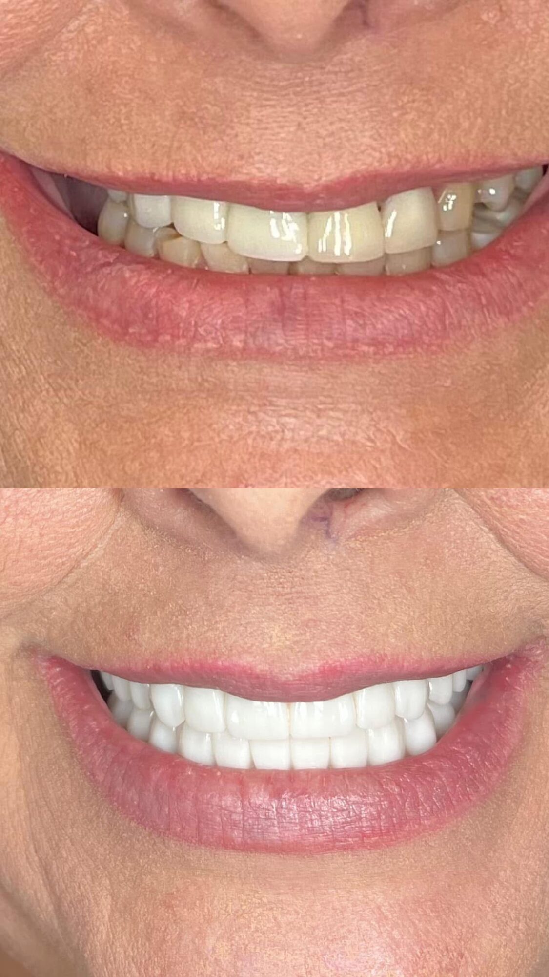 Close-up of a smiling person's mouth showing teeth before and after dental work, with visible improvement in alignment and whiteness.